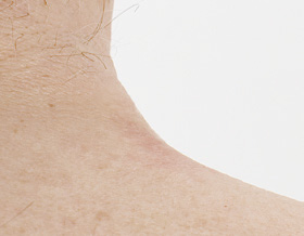 nach Behandlung Fibrom