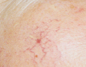 vor Behandlung Spider Naevus